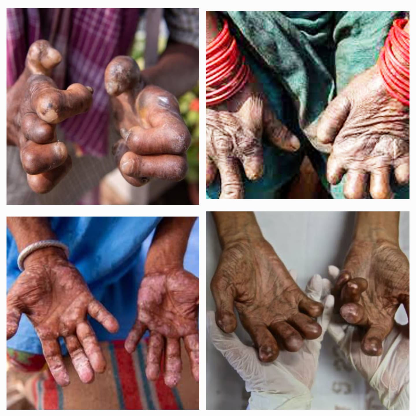 कुष्ठरोग - Leprosy