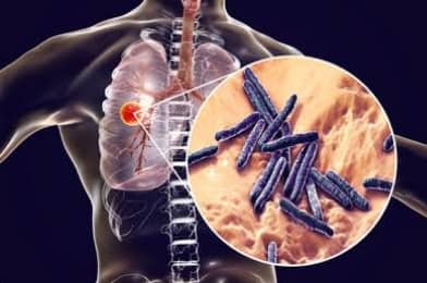 क्षयरोग – Tuberculosis