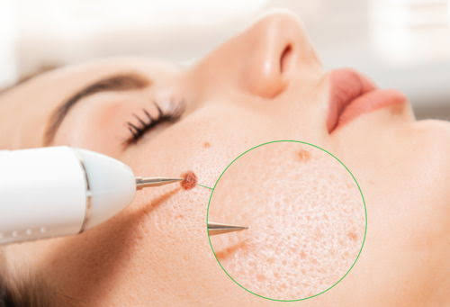 रेडिओफ्रिक्वेन्सी (RF) आणि इलेक्ट्रोकॉटरी