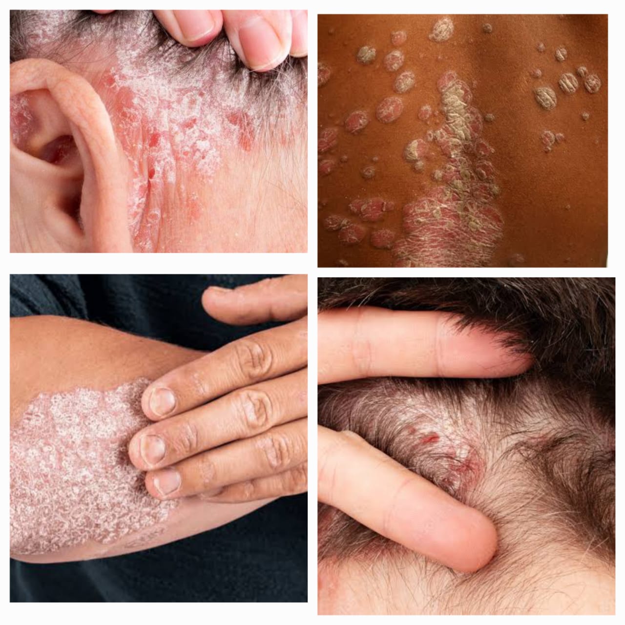 मानधणे स्किन केअर क्लिनिक - सोरायसिस (Psoriasis)