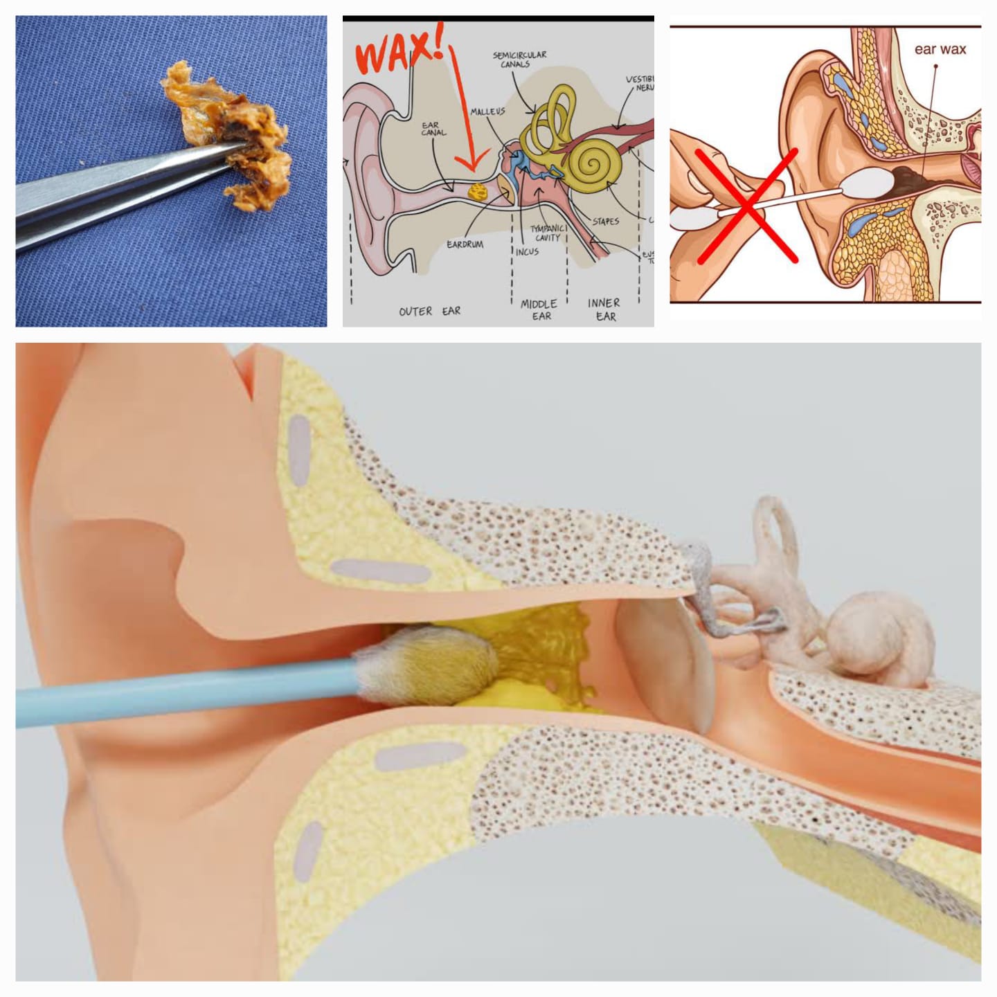 कानातील मळ - Ear wax