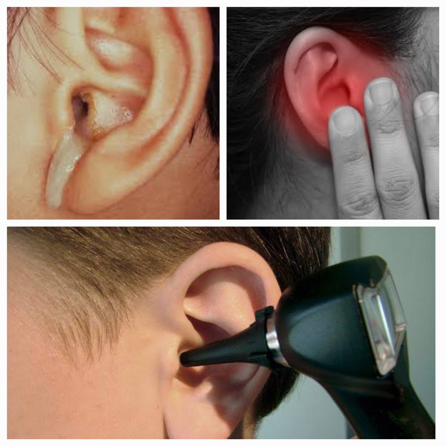 कानातून पाणी येणे – Ear Discharge