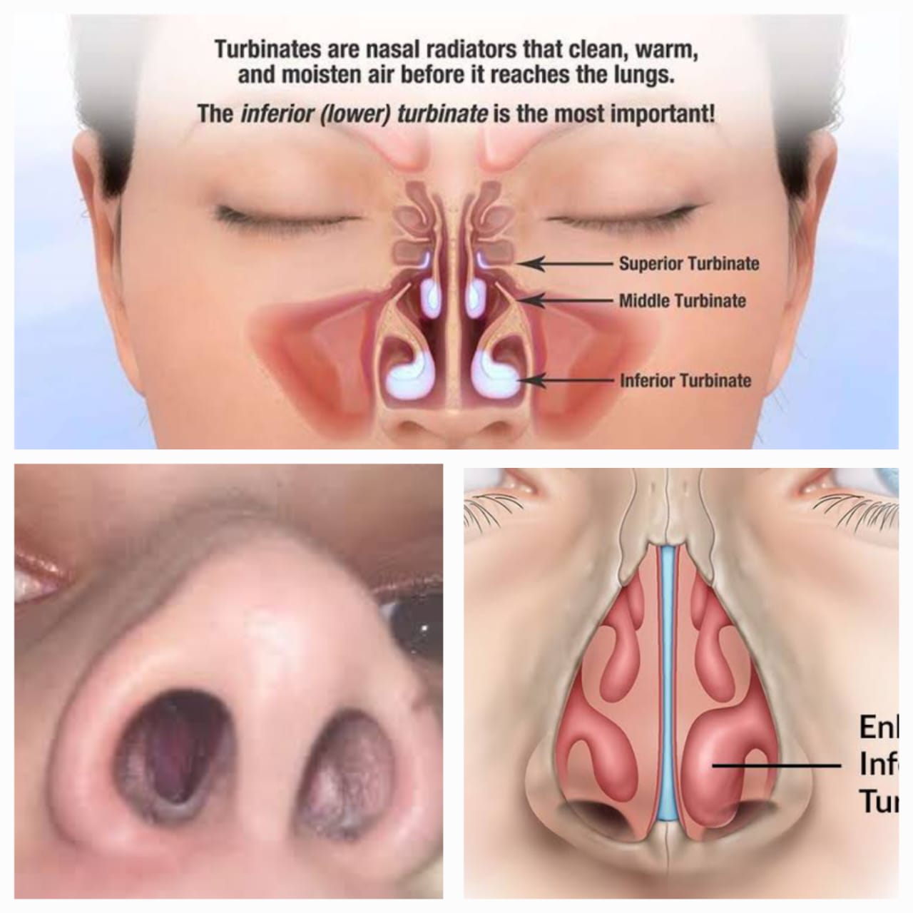 नाकाचे हाड वाढणे