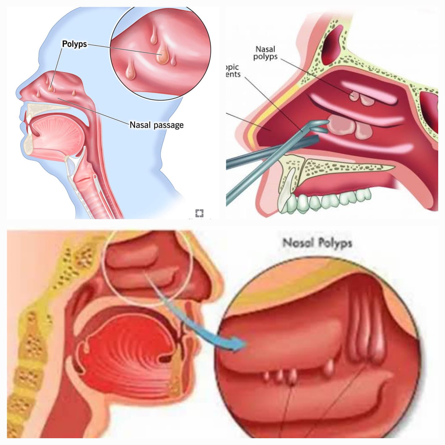 नाकात मांस वाढणे – Nasal Polyps
