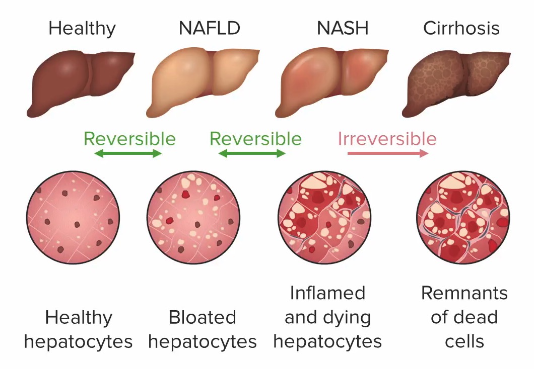 LIVER FUNCTION TEST